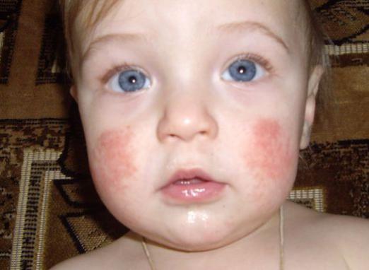 Än att behandla en dermatit hos barnet?
