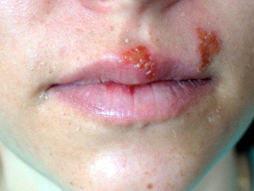 Än att behandla herpes?